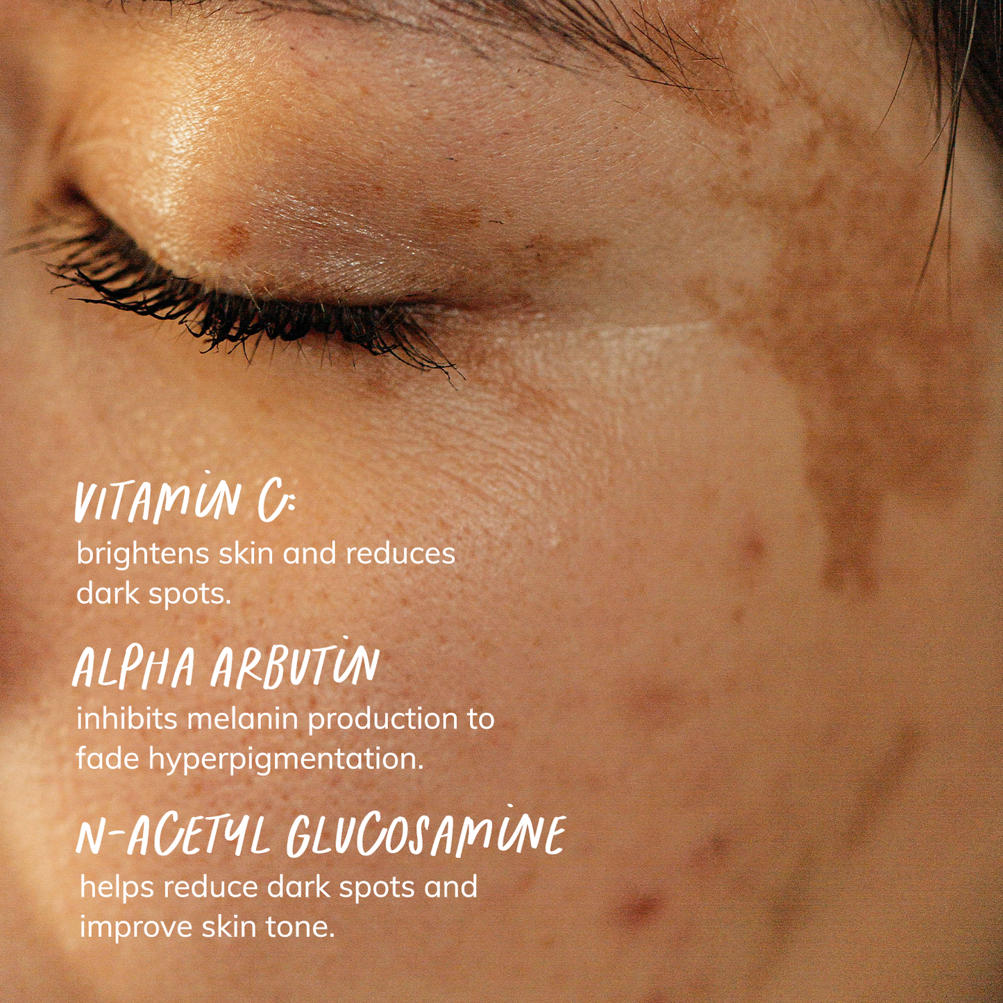 Spotless: Targeted Face Serum Solution for Hyperpigmentation & Dark Spots